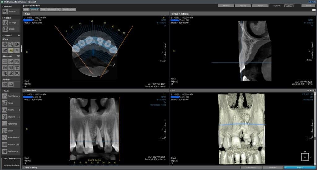 Otvorena CBCT snimka u CDVieweru